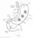 Fig. 25 - CLOSED LOOP GASTRIC RESTRICTION DEVICES AND METHODS