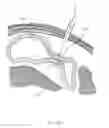 Fig. 34 - CLOSED LOOP GASTRIC RESTRICTION DEVICES AND METHODS