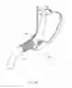 Fig. 41 - CLOSED LOOP GASTRIC RESTRICTION DEVICES AND METHODS