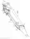 Fig. 04 - Surgical handpiece for endoscopic resection