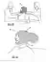 Fig. 06 - WOUND CARE DEVICE