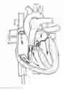 Fig. 01 - Method of using catheter with rotating portion