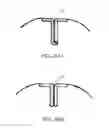 Fig. 04 - Simple device for treating tinea unguium