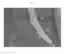 Fig. 06 - Methods and Compositions to Facilitate Repair of Avascular Tissue