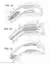 Fig. 02 - Endoprosthesis