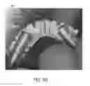 Fig. 43 - Expandable slide and lock stent