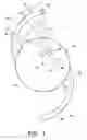 Fig. 02 - Intraocular lens