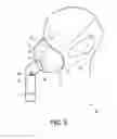 Fig. 07 - Respiratory interface device with flexible cover