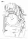 Fig. 05 - Hearing aid with audio shoe