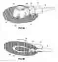 Fig. 06 - Implantable coupling device