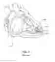 Fig. 02 - Catheter with distensible and frangible cap