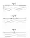 Fig. 07 - Stent suitable for deployment in a blood vessel