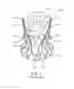Fig. 02 - Sheath for Controlled Delivery of a Heart Valve Prosthesis