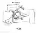Fig. 08 - Positioning device for ankle joint replacement surgery