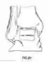Fig. 10 - Positioning device for ankle joint replacement surgery