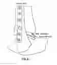 Fig. 11 - Positioning device for ankle joint replacement surgery