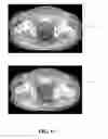 Fig. 17 - Methods of scatter correction of x-ray projection data 2