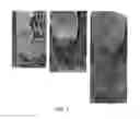 Fig. 02 - METHODS AND RELATED KITS FOR TREATING AND REGENERATING TOOTH PULP AND PERIAPICAL TISSUES IN A MAMMAL