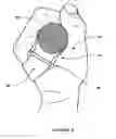 Fig. 05 - Bar grip