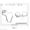 Fig. 03 - Computer-aided osteoplasty surgery system