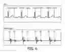 Fig. 04 - METHOD AND SYSTEM FOR PROCESSING HEART SOUND SIGNALS