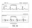 Fig. 08 - METHOD AND SYSTEM FOR PROCESSING HEART SOUND SIGNALS