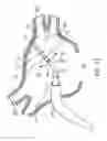 Fig. 13 - METHODS AND SYSTEMS FOR ABLATING TISSUE