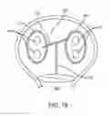 Fig. 20 - METHODS AND SYSTEMS FOR ABLATING TISSUE