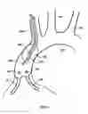 Fig. 10 - Systems, methods and devices for circulatory access