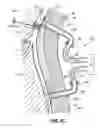 Fig. 63 - Systems, methods and devices for circulatory access