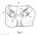 Fig. 04 - Forehead support for a patient interface