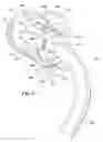 Fig. 07 - Ventilator to tracheotomy tube coupling