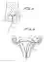 Fig. 05 - Fallopian Tube Occlusion Device