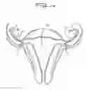 Fig. 08 - Fallopian Tube Occlusion Device