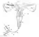 Fig. 01 - Methods and apparatus for occluding reproductive tracts to effect contraception