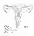 Fig. 04 - Methods and apparatus for occluding reproductive tracts to effect contraception