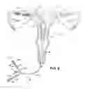 Fig. 05 - Methods and apparatus for occluding reproductive tracts to effect contraception
