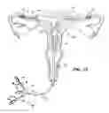Fig. 09 - Methods and apparatus for occluding reproductive tracts to effect contraception
