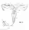 Fig. 10 - Methods and apparatus for occluding reproductive tracts to effect contraception