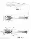 Fig. 13 - Methods and apparatus for occluding reproductive tracts to effect contraception