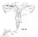 Fig. 14 - Methods and apparatus for occluding reproductive tracts to effect contraception