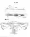 Fig. 15 - Methods and apparatus for occluding reproductive tracts to effect contraception