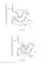 Fig. 35 - Catheter apparatuses, systems, and methods for renal neuromodulation