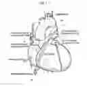 Fig. 08 - Balloon catheter system