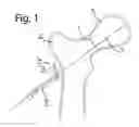 Fig. 02 - Device for fixation of bone fragments at bone fractures