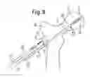 Fig. 09 - Device for fixation of bone fragments at bone fractures
