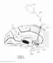 Fig. 04 - MULTIPLE ELECTRODE LEAD AND A SYSTEM FOR DEEP ELECTRICAL NEUROSTIMULATION INCLUDING SUCH A LEAD