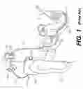 Fig. 02 - Cochlear implant component having a unitary faceplate