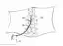 Fig. 01 - Spinal Cord Stimulator Lead Anchor