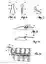 Fig. 03 - Spinal Cord Stimulator Lead Anchor